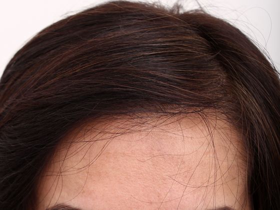 Hair Transplant - Female Hairline FUT (5) - After