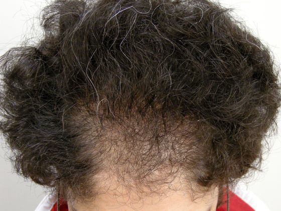 Hair Transplant - Female: Frontal FUT (2) - Before female hair transplant