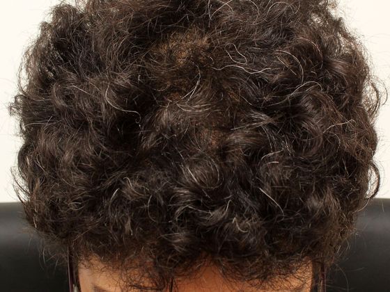 Hair Transplant - Female: Frontal FUT (2) - After female hair transplant