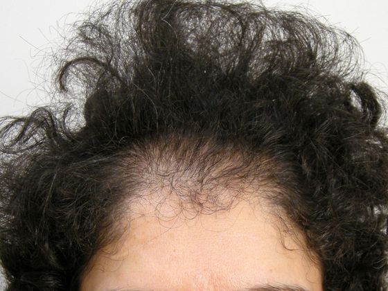 Hair Transplant - Female: Frontal FUT (2) - Before female hair transplant
