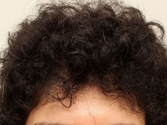 Hair Transplant - Female: Frontal FUT (2) - After female hair transplant