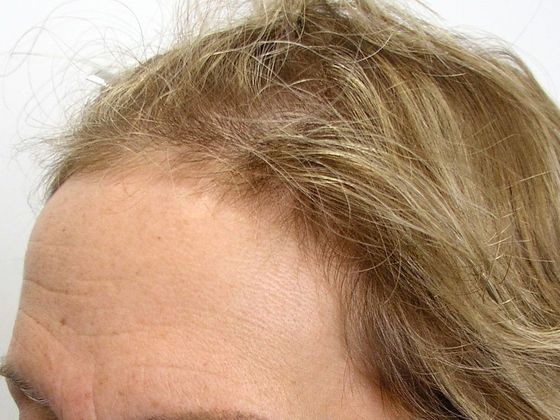 Hair Transplant - Female: Hairline FUT (9) - Before female hair transplant