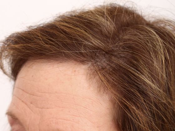 Hair Transplant - Female: Hairline FUT (9) - After female hair transplant