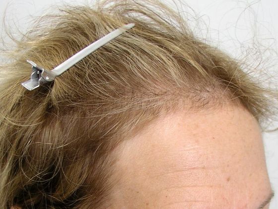 Hair Transplant - Female: Hairline FUT (9) - Before female hair transplant