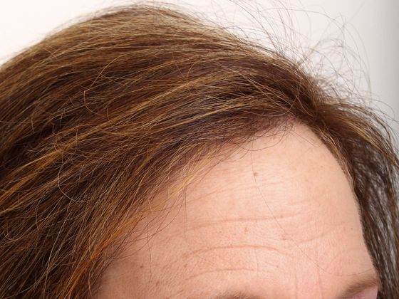 Hair Transplant - Female: Hairline FUT (9) - After female hair transplant