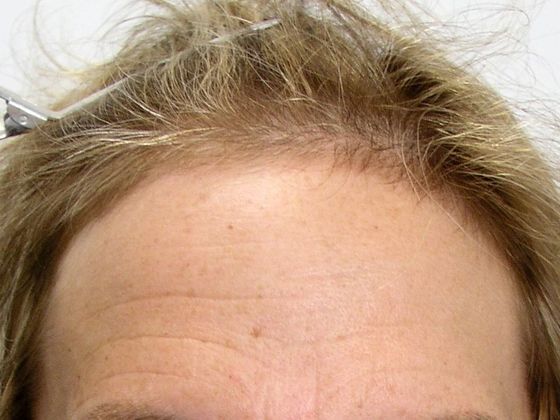 Hair Transplant - Female: Hairline FUT (9) - Before female hair transplant