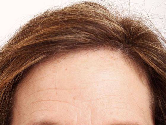 Hair Transplant - Female: Hairline FUT (9) - After female hair transplant