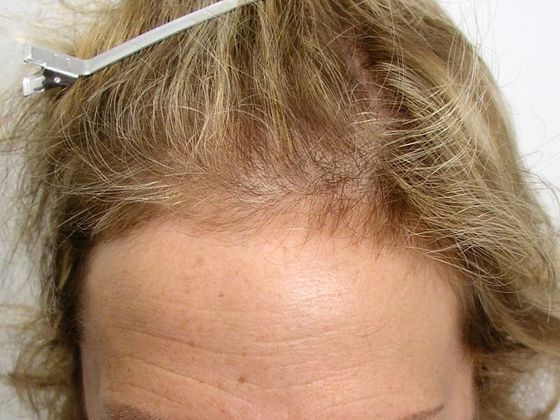 Hair Transplant - Female: Hairline FUT (9) - Before female hair transplant