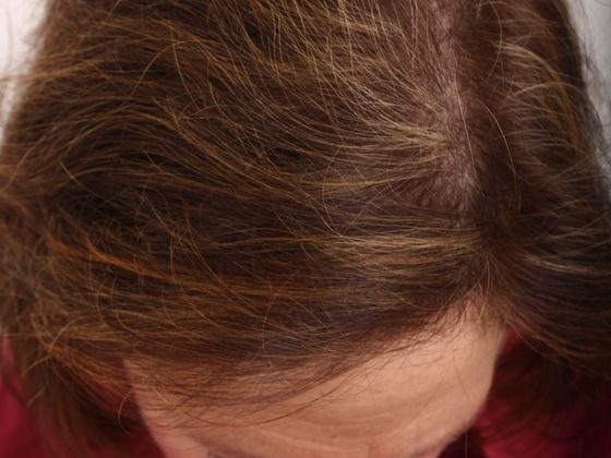 Hair Transplant - Female: Hairline FUT (9) - After female hair transplant