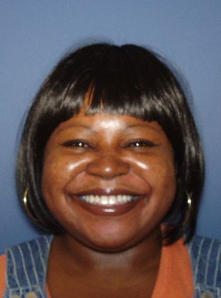 Tooth Spacing Lower Spaces - Before