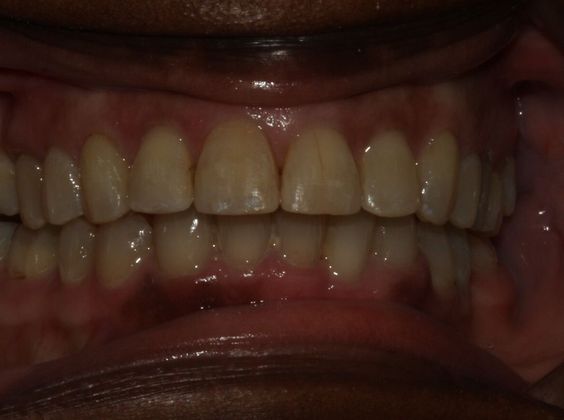 Tooth Spacing Adult Diastema - After