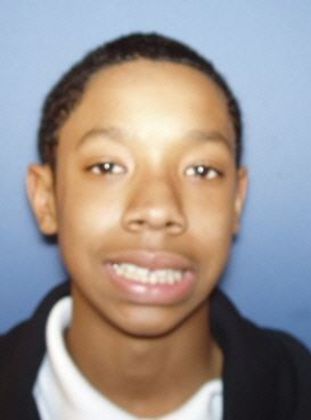 Tooth Spacing: Diastema and Over Bite - Before