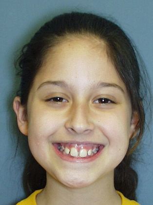 Tooth Spacing Deep Bite and Spaces - Before