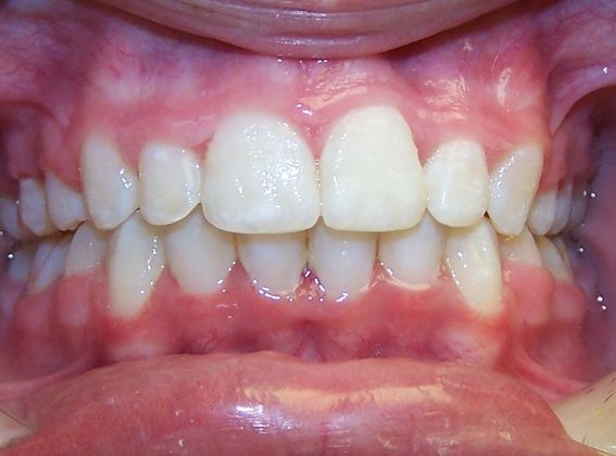 Tooth Spacing: Spaces and Narrow Arch - After