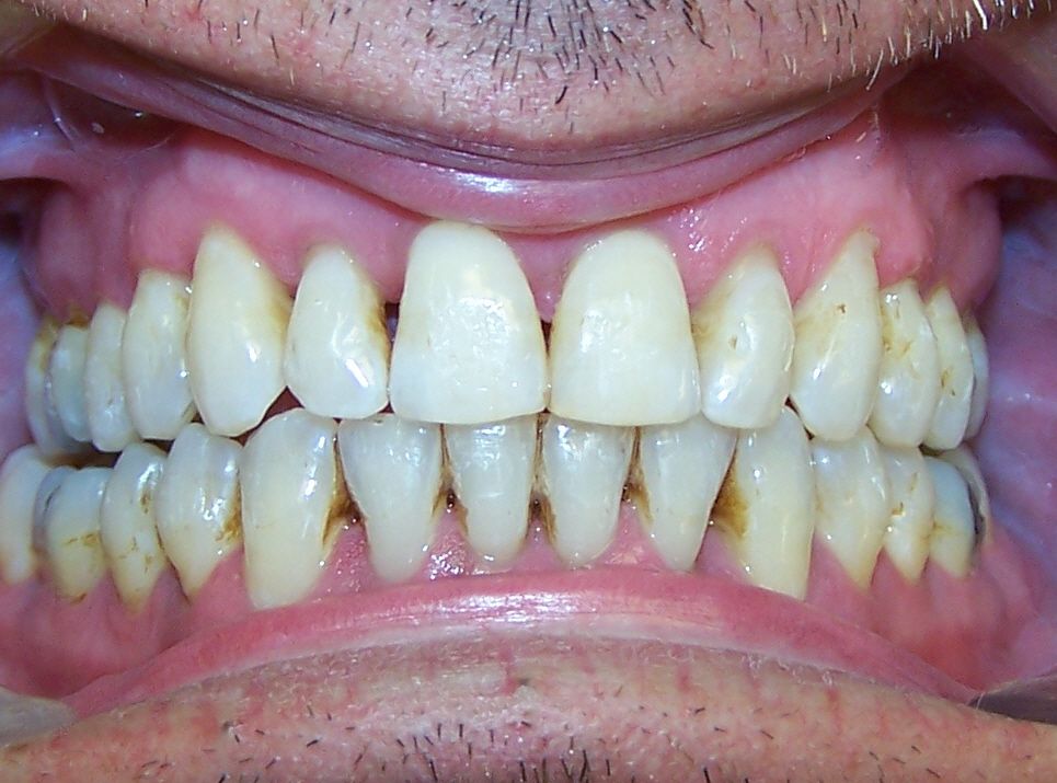 Periodontal and Open Bite Periodontics and Braces Before and After