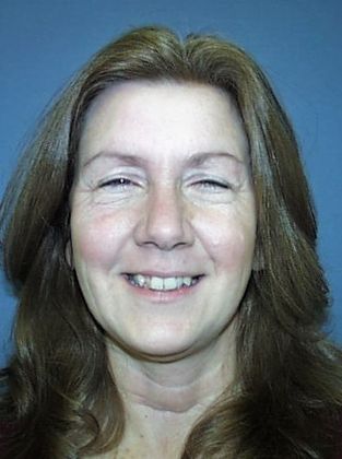 Periodontics and Braces Periodontal and Anterior Cross Bite - Before