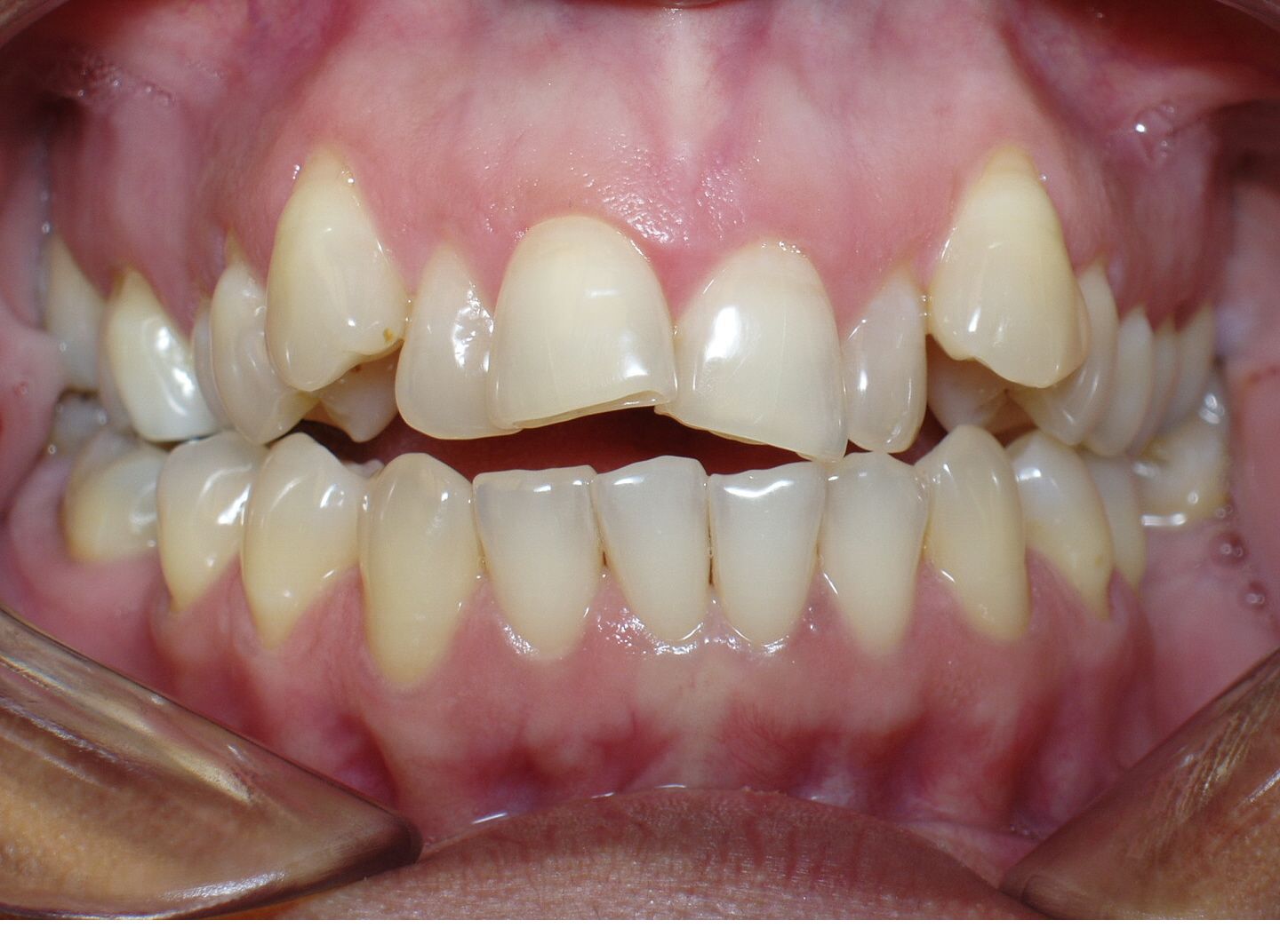 Periodontal and Narrow Arch Periodontics and Braces Before and