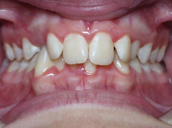 How to Keep Clear Braces From Turning Yellow