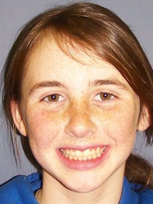 Narrow Arch - Narrow Smile: Very Narrow Arch and Deep Bite - After