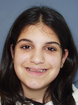 Open Bite: Open Bite and Narrow Arch - Before