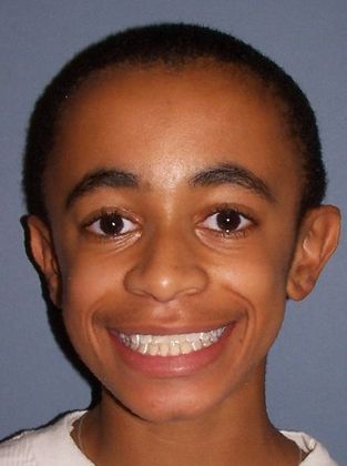 Under Bite with NO Surgery: Phase I Under Bite - After