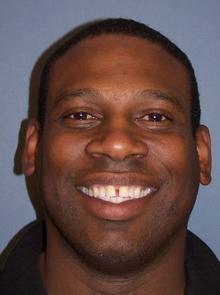 Tooth Spacing Diastema - Before