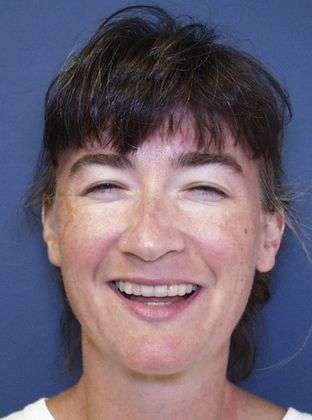 Periodontics and Braces: Periodontal,Over Crowded and Narrow Arch - After