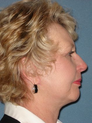 Face & Neck Lifts: Case 8 - After - Side