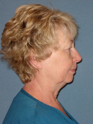 Face & Neck Lifts: Case 8 - Before - Side
