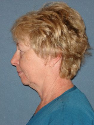 Face & Neck Lifts: Case 8 - Before - Side