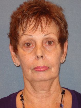 Laser Skin Resurfacing Case 7 - Before