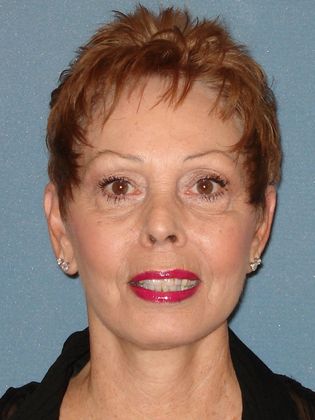 Laser Skin Resurfacing Case 7 - After