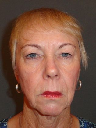 Upper Eyelid Surgery: Case 61 - Before