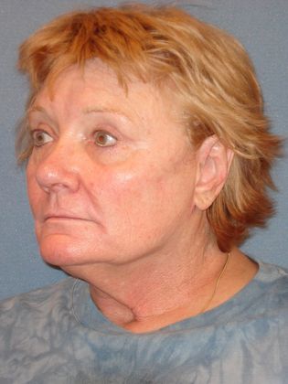 Face & Neck Lifts: Case 11 - After - Side