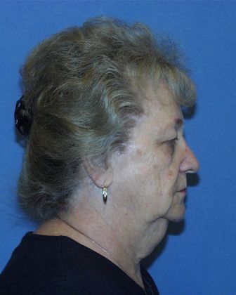 Face & Neck Lifts: Case 13 - Before - Side
