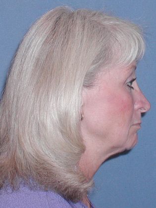 Face & Neck Lifts: Case 14 - Before - Side