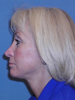 Face & Neck Lifts: Case 14 - After - Side