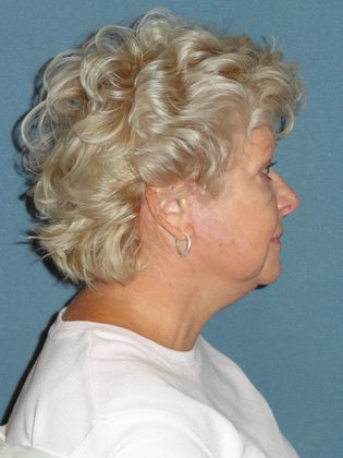 Face & Neck Lifts: Case 15 - After - Side
