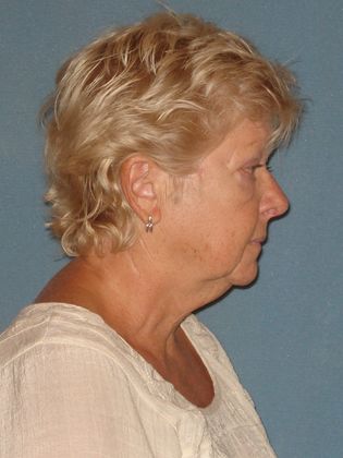 Face & Neck Lifts: Case 15 - Before - Side