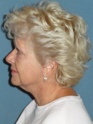 Face & Neck Lifts: Case 15 - After - Side