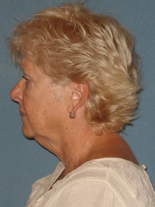 Face & Neck Lifts: Case 15 - Before - Side