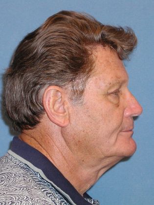 Brow Lift: Forehead and Eyebrow Lift Improve Vision - After - Side