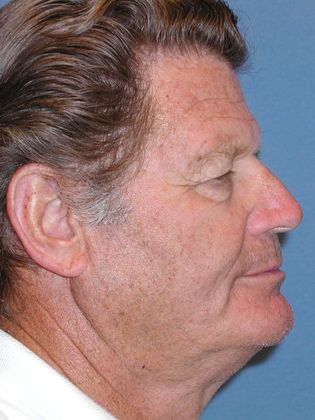 Brow Lift: Forehead and Eyebrow Lift Improve Vision - Before - Side