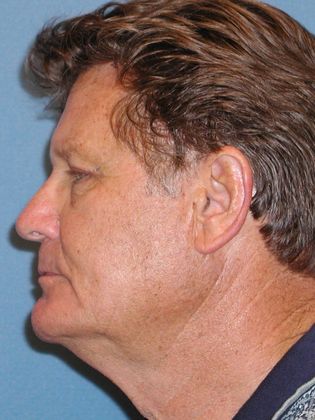 Brow Lift: Forehead and Eyebrow Lift Improve Vision - After - Side