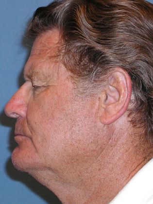 Brow Lift: Forehead and Eyebrow Lift Improve Vision - Before - Side