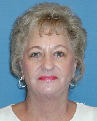 Laser Skin Resurfacing Case 12 - After