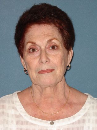 Laser Skin Resurfacing Case 16 - Before