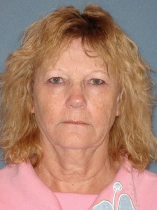 Laser Skin Resurfacing Case 17 - Before