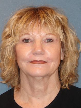 Laser Skin Resurfacing Case 17 - After