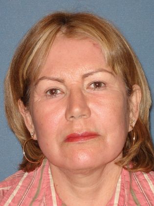 Laser Skin Resurfacing Case 18 - After